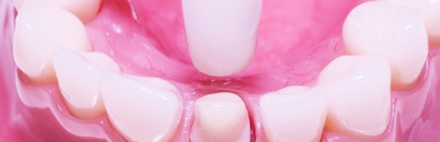Dental Veneers: What Factors Influence its Cost?