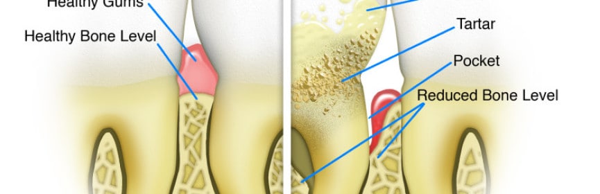 Prevention of Gum Diseases by Regular Dental Check Up