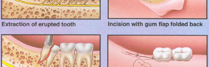 Cost of Wisdom Tooth Removal Extraction