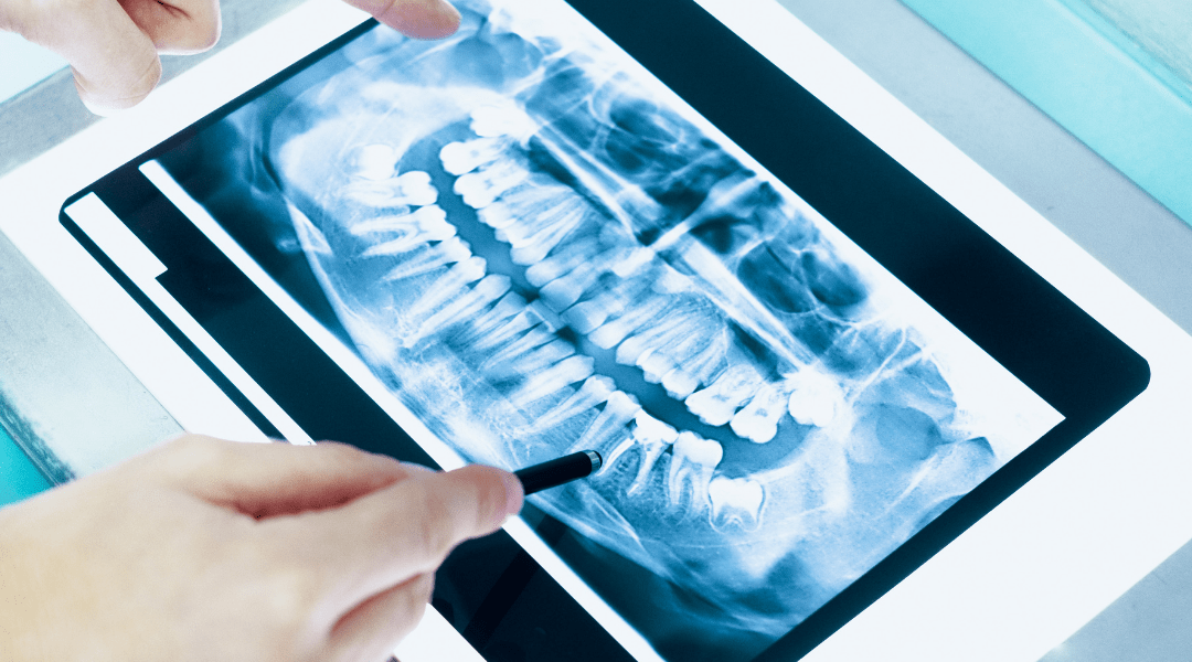 Tooth Replacement Options in Thornhill