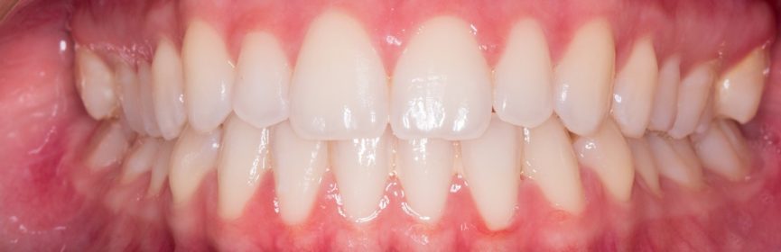 Treatment for Receding Gums in Thornhill
