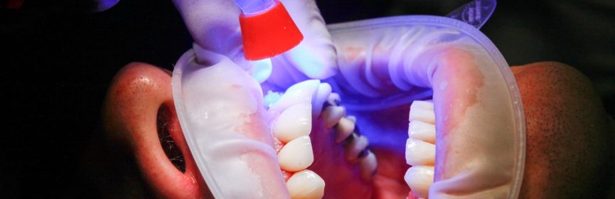 What is Laser Teeth Whitening Cost in Thornhill?