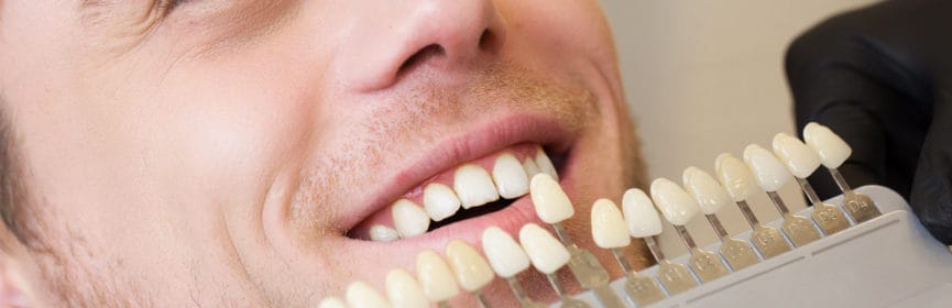 How Much Does Veneers Cost in Canada?