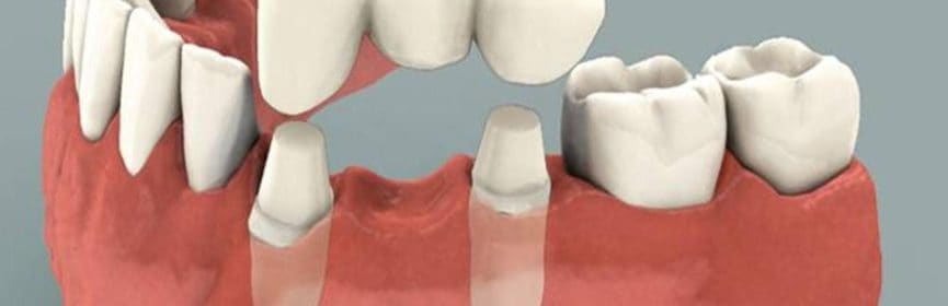 Cost of a Dental Bridge in Thornhill Ontario