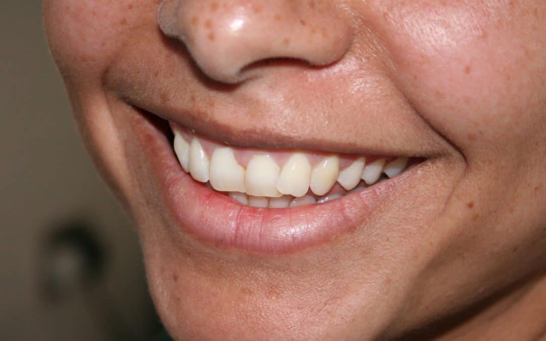 How Much is the Cost of Dental Sealants for Adults?