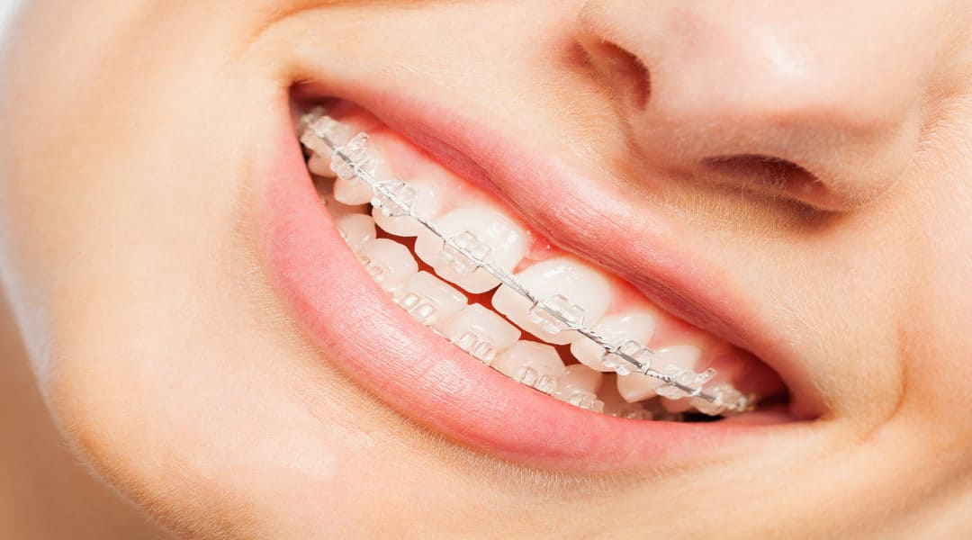 Have Straighter Teeth With Ceramic Dental Braces