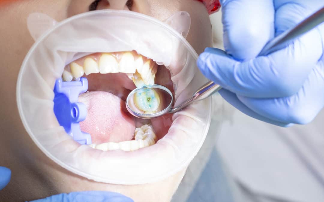 How Long Is The Wisdom Tooth Extraction Procedure?