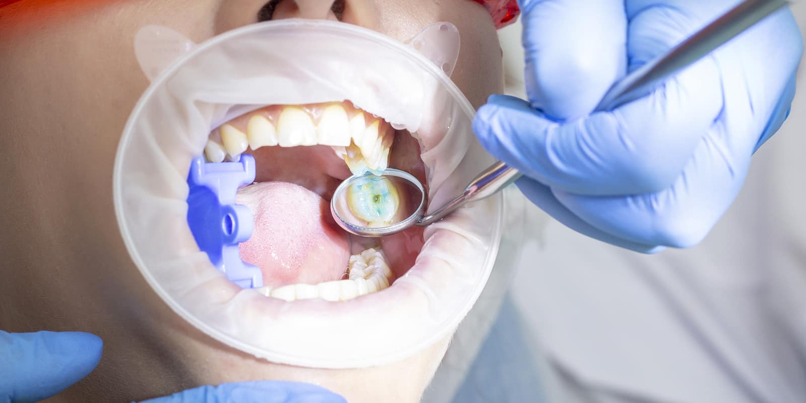Is Wisdom Tooth Extraction Treatment A Simple Process