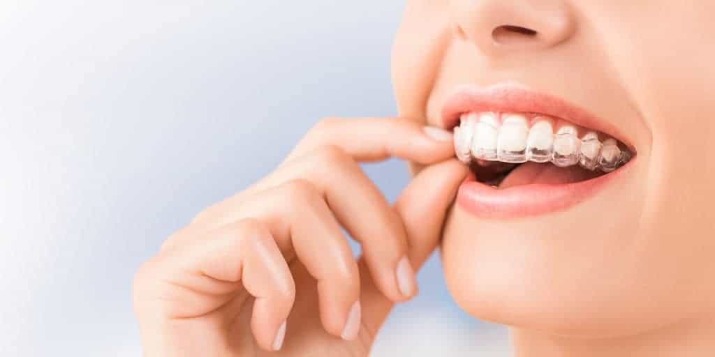 affordable invisalign in Thornhill Ontario - Thornhill dentists by World Dental