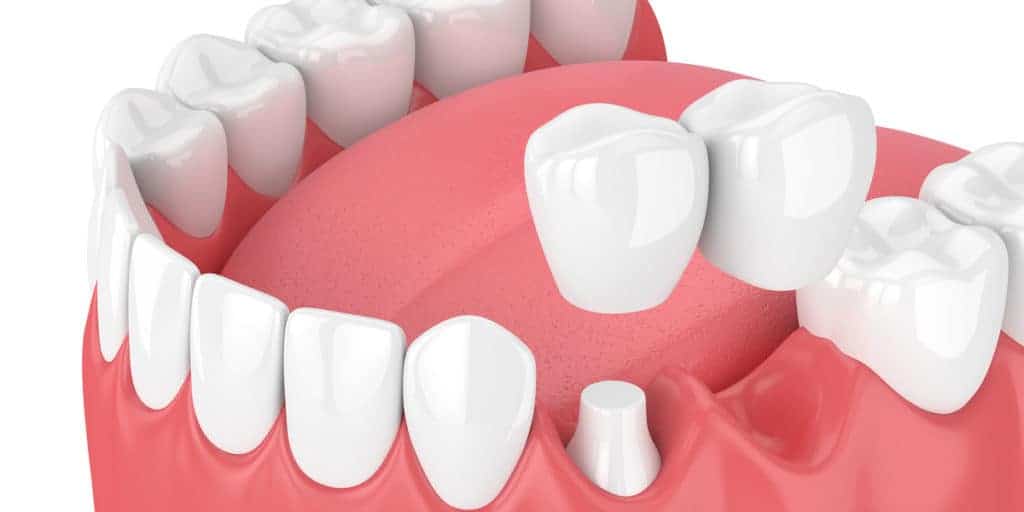 dental bridge - Thornhill dentists by World Dental