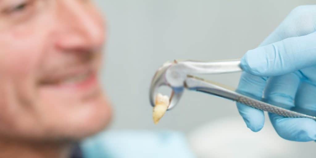 wisdom tooth extraction - Thornhill dentists by World Dental