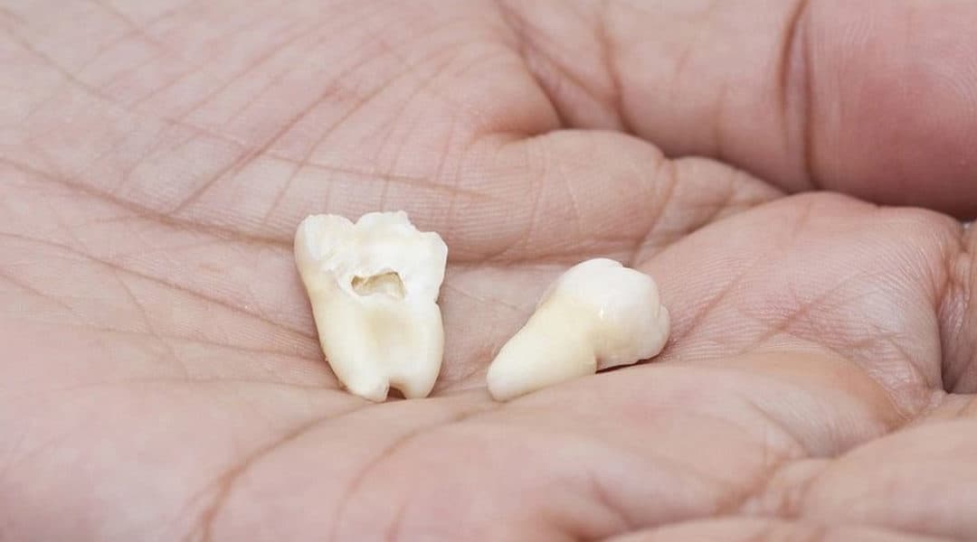 Easy Guide On The Cost To Remove Wisdom Teeth Thornhill