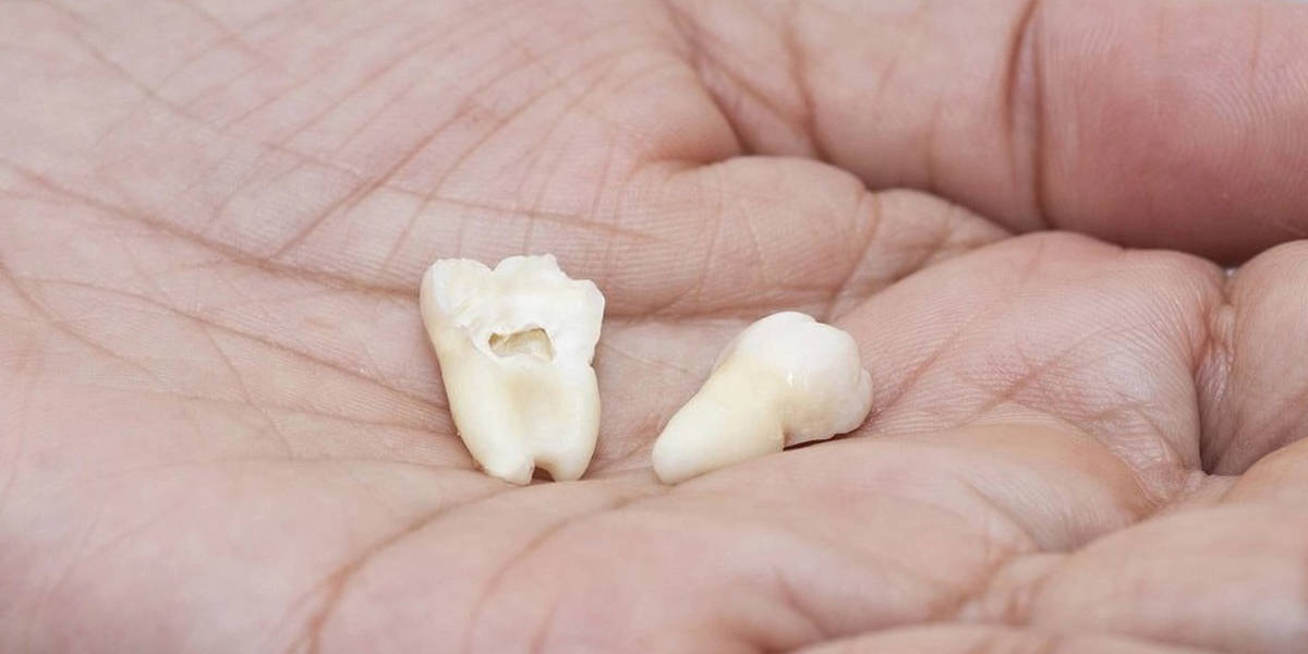 extractions with wisdom tooth removal - Thornhill dentists by World Dental
