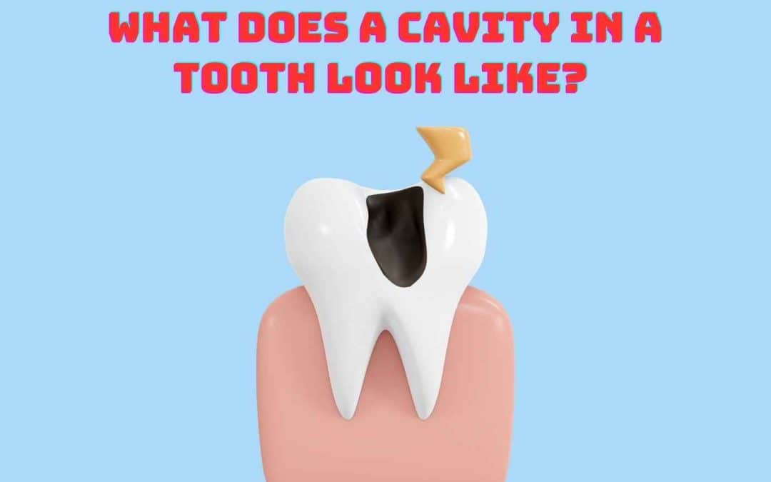 What Does a Cavity in a Tooth Look Like? Recognizing Signs of Tooth Decay