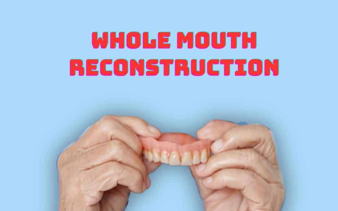 Whole Mouth Reconstruction: Restoring Your Smile and Oral Health